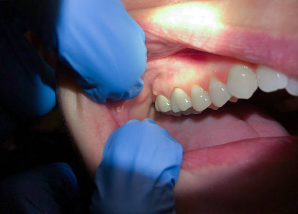 Best Emergency Dental Care for Broken or Chipped Teeth in Princeton, WI