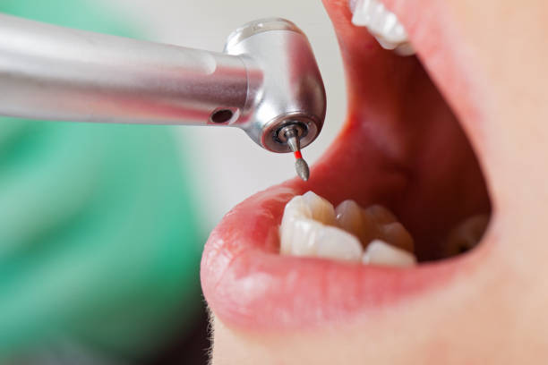 Best Emergency Dental Care for Broken or Chipped Teeth in Princeton, WI